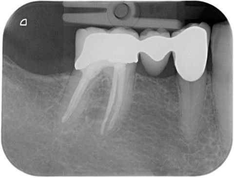 Wurzelfüllung Zahn 46
